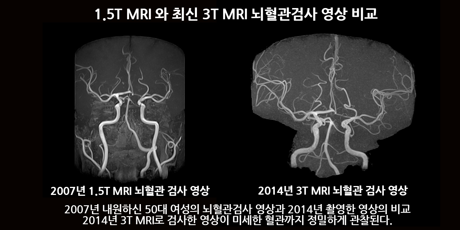 차이 mra mri 뇌 MRI,